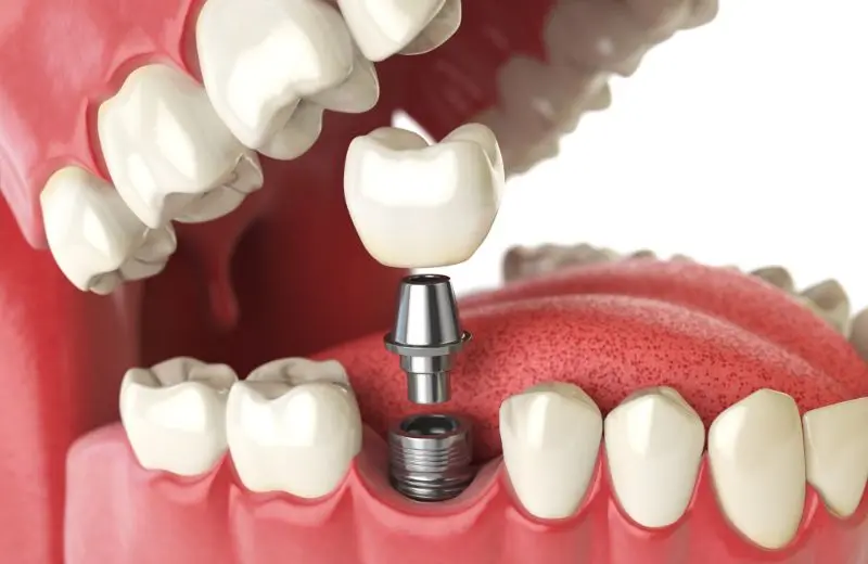 Custom implant-supported dentures fitted at Recreate Smiles dental clinic Perth