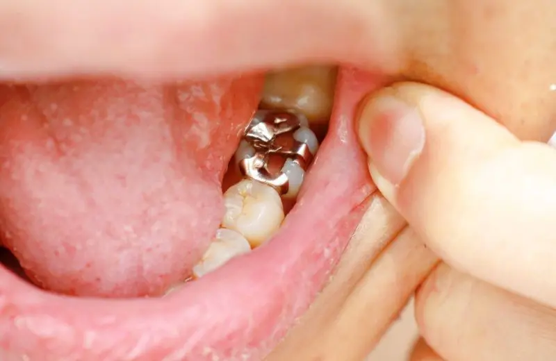 Tooth-coloured composite filling being placed at Recreate Smiles dental clinic