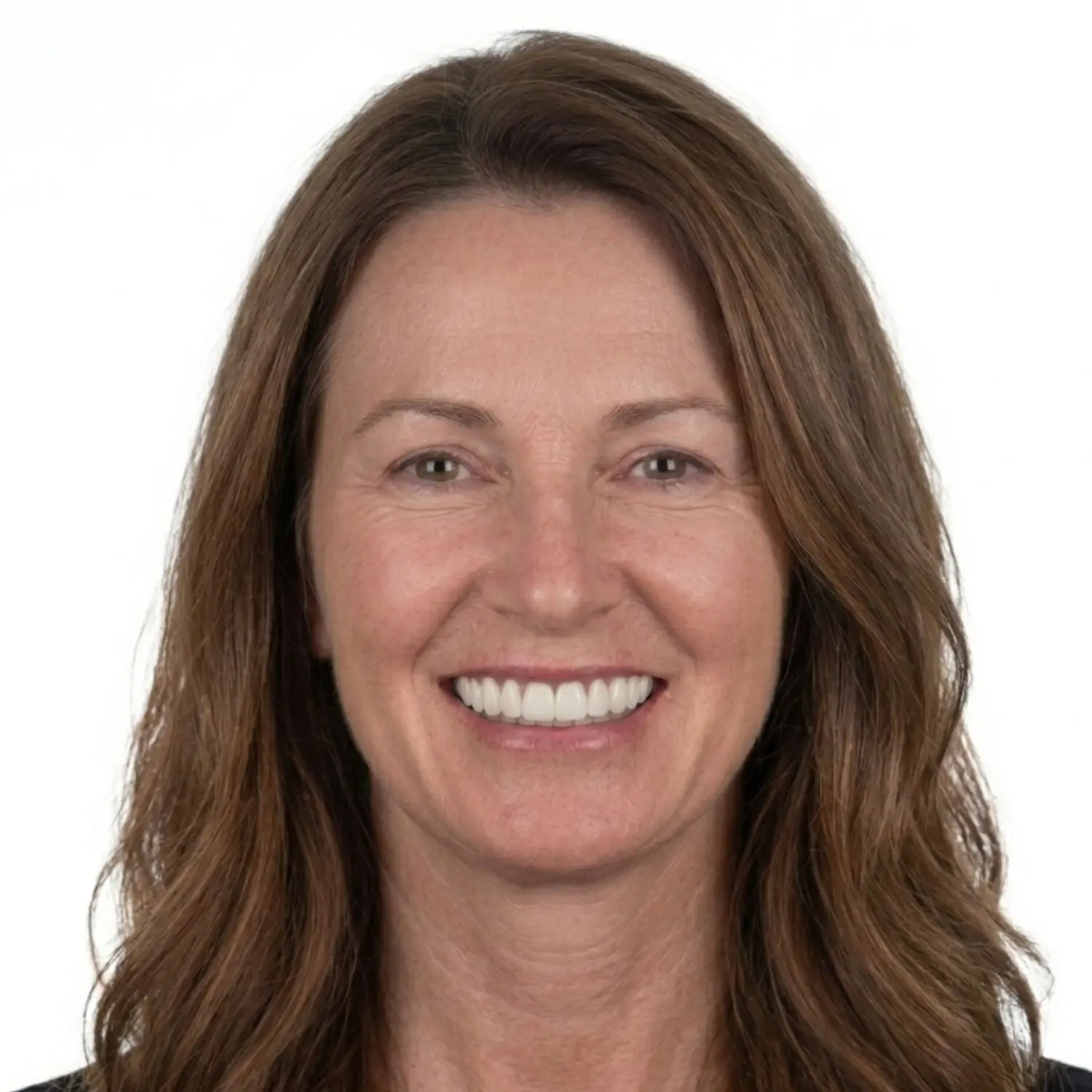 Full arch All-on-X implants, Recreate Smiles Perth