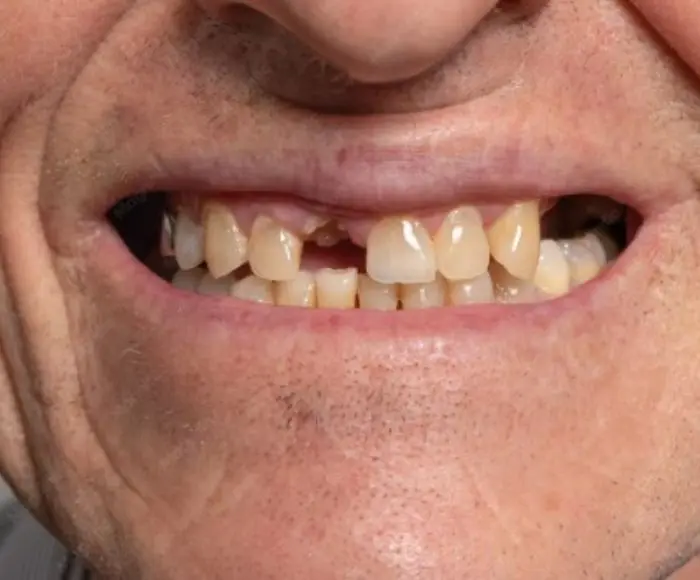 Single implant case photo, Recreate Smiles Perth